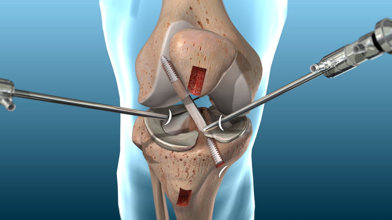 Arthroscopic ACL Surgery