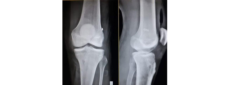 Arthroscopic Surgeon in Thane