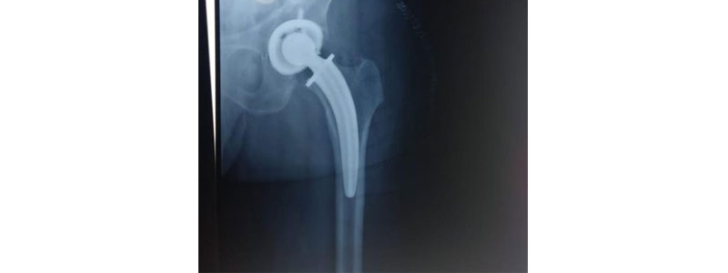 Hip Replacement Surgeon in thane