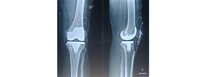 Knee Replacement Knee Replacement Doctor in Thane