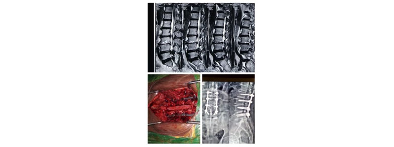 Spine Specialist in Thane